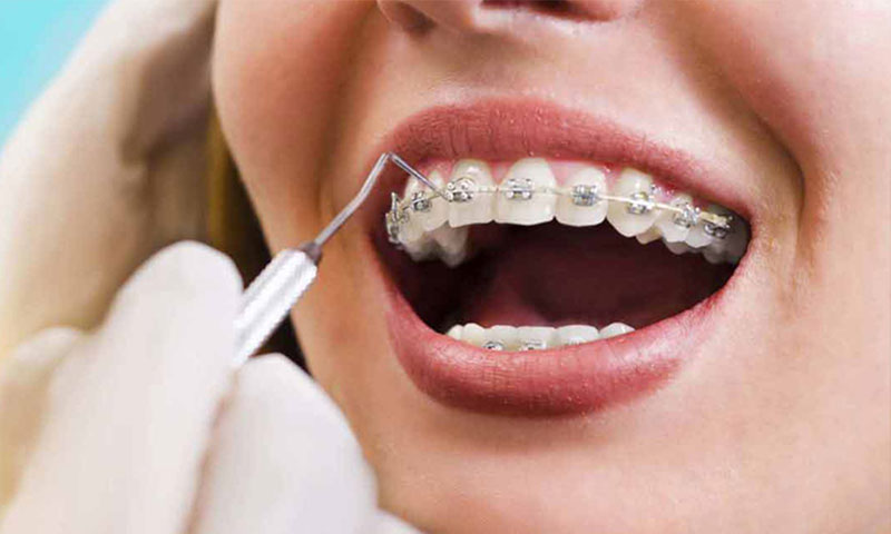 مزایای استفاده از ارتودنسی ثابت دندان
