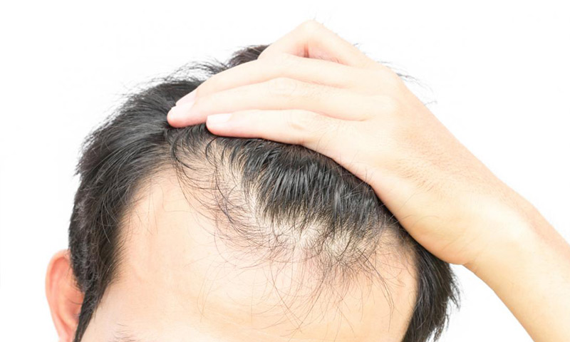 داروهای طبیعی برای درمان ریزش مو